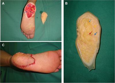 Case report: Microsurgical replantation of heel skin and subcutaneous tissue